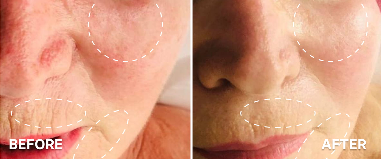 Ageless-Microneedling-1
